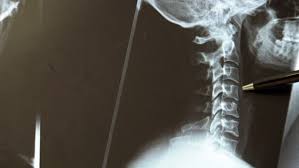 Halswirbelsaulen Syndrom Ausloser Fur Schwindel Ndr De Ratgeber Gesundheit