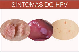 Geralmente, ele é banido pelo próprio sistema imunológico, que tem a função de evitar há organismos que não conseguem se livrar do vírus sozinhos. Pomada De Barbatimao Pode Ser A Cura Do Hpv Tua Saude