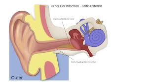 This can happen for many reasons and causes fluid to build up behind the eardrum which in turn can become infected. Ear Infections Ear Institute Of Texas And Voice Swallowing Institute Of Texasear Institute Of Texas And Voice Swallowing Institute Of Texas