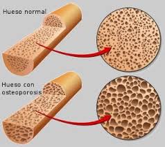 Resultado de imagen para imagenes de osteoporosis