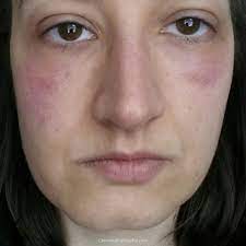 Rash On My Face Histamine Intolerance Chronically Hopeful Face Allergic Reaction Rash On Face Hives On Face