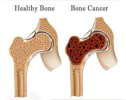 Bone Cancer - Dr. ReshmaPuranik