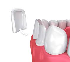 Ultimately, their longevity depends on how well you take care of your dental health. Veneers Kenilworth Il Evanston Il Glenview Il Porcelain Veneers Art Carpenter Dds Ltd