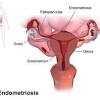 Uterine cancer is the most common cancer of the female reproductive tract. 1