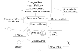 Image result for Cheyne-Stokes Respiration