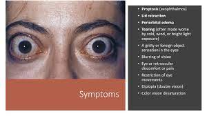 Thyroid Eye Disease Youtube