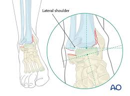 Fractures of the human ankles. Malleoli Fracture Management With Minimal Resources