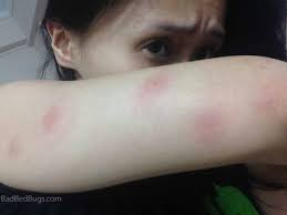 Bug Bite With Black And Blue Ring Around It What Do Bed Bug Bites Look Like