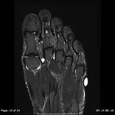 Muscle atrophy in the plantar foot muscles using mri techniques in similar subjects. Https Med Mahidol Ac Th Radiology Sites Default Files Public Meet17 Issrop Foot Mriissrop Pdf
