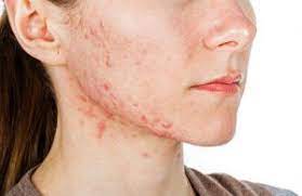 For many struggling with acne, achieving hormone balance is key. Was Ist Akne Welche Arten Es Gibt 14 Tipps Zur Behandlung