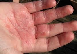 Image result for dermatitis contacta