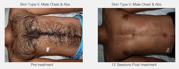 permanent hair removal with cal