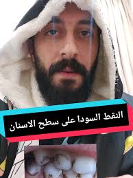 سبب سواد الاسنان