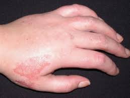 Eschara) is a slough or piece of dead tissue that is cast off from the surface of the skin, particularly after a burn injury, but also seen in gangrene, ulcer, fungal infections, necrotizing spider bite wounds, tick bites associated with spotted fevers, and exposure to cutaneous anthrax.the term eschar is not interchangeable with scab. Chemical Burn Dermnet Nz