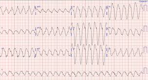You will see that the morphology is quite different to the ecg above. Dr Smith S Ecg Blog Wide Complex Tachycardia Vt Aberrant Or Other