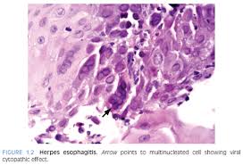 Cytomegalovirus esophagitis is a form of esophagitis associated with cytomegalovirus. Gastrointestinal System Obgyn Key