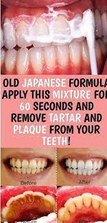 Removing plaque from your teeth daily is crucial to avoid tartar buildup & further issues. How To Remove Black Tartar Between Teeth Teethwalls