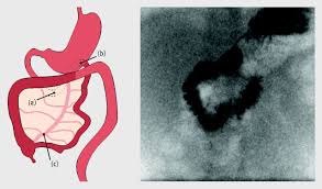 Image result for Intestinal Malrotation
