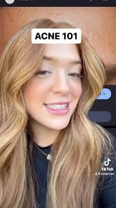 ACNE 101 💙, What is Acne? , -Acne is an inherited disorder of the pores