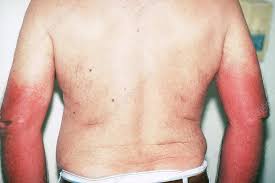 Image result for Photodermatitis