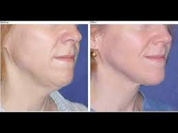 Pin On Skin Tightening After Pregnancy