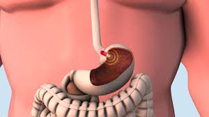 Image result for Wireless Capsule Endoscopy