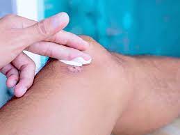 How To Get Rid Of Old Scars: Top 10 Remedies