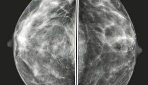 What does breast dcis look like. Mammogram Images Normal Abnormal And Breast Cancer