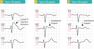Brugada Syndrome Ecg Clinical Features And Management Ecg Echo
