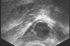 Wenn sie in der 5.woche war,dann kann ich laut berechnung der vater sein,oder wird beim ultraschall eine woche oder 2 nicht dazugerechnet ich wurde in beiden schwangerschaften nie zuerst nach der letzten periode gefragt, sondern immer erst us, dann hat er gesagt sie sind in woche xyz, wann war. Follikel Anzahl Grosse Entwicklungsstufen