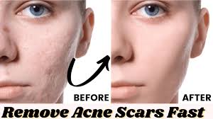 Maybe you would like to learn more about one of these? Getridofacnescars Hashtag On Twitter