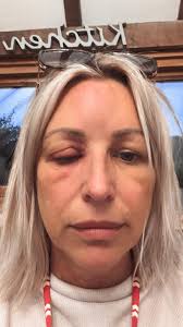 Hello maybe abit of a random one. Unfortunately I suffer from coldsores  especially when im stressed and im really worried that i will get one right  before my wedding and cant kiss