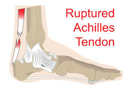 The bones in a person's skeleton enable him or her to walk, run, jump, roll, lift, carry, drop, and do other important. Achilles Tendon Ruptures