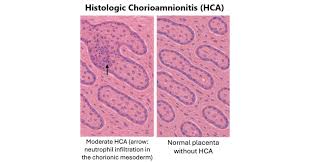 Image result for Chorioamnionitis