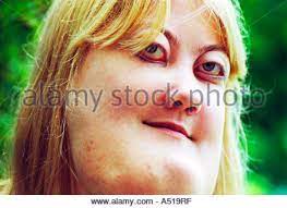 Find people with cherubism through the map. A Young Woman With Cherubism The Rare Genetic Condition Is A Hereditary Form Of Polyostotic Fibrous Dysplasia Stock Photo Alamy