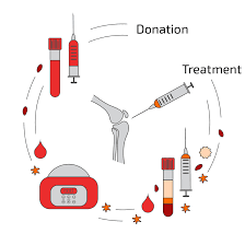 Bone Marrow Concentrate Bmc Anova Irm Germany