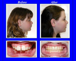 Maybe you would like to learn more about one of these? How To Correct Overbite With Braces Arxiusarquitectura