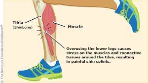 Shin Splints (For Parents) - Nemours