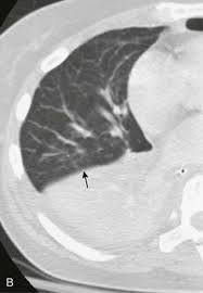 Image result for Air Bronchogram