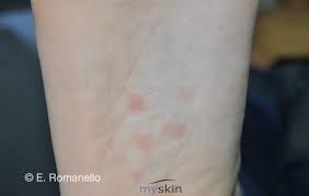 Questo problema può essere provocato da svariate cause. Sifilide Lue La Guida Completa Myskin Dermatologi Online