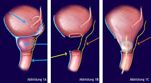 Image result for Radical Prostatectomy