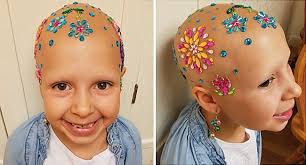 With this condition, your body mistakenly views your hair. 7 Year Old Girl With Alopecia Shows How Baldness Is Beautiful