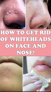 How To Get Rid Of Whiteheads On Nose And Face Dry Skin On Face Pimples On Face Blackheads On Nose