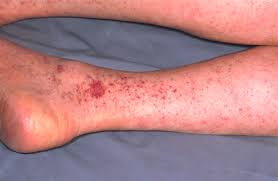 Maybe you would like to learn more about one of these? Rocky Mountain Spotted Fever Infectious Dis Medbullets Step 2 3