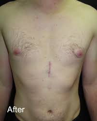 Image result for Pectus Excavatum