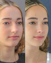 El edema nasal es una secuela posquirúrgica y postraumática muy frecuente,  ya que se alteran los vasos sanguíneos y los ganglios, produciendo una  deficiencia en el sistema linfático. 👉🏻Como consecuencia se producen