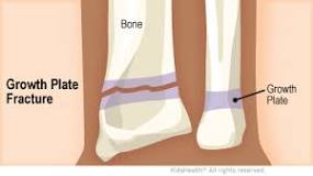 Growth Plates (for Parents) | Nemours KidsHealth
