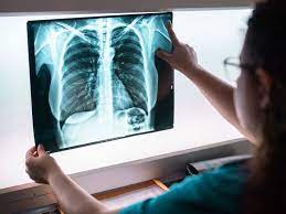 There could still be cancer in other places. Lung Cancer Pictures Ct Scan X Ray And More