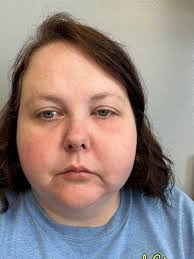 Please help!!! I had a tooth extracted two days ago and a abscess drained.  Today I'm in the worst pain ever goes this look like normal healing???