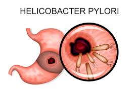 Ein Drittel Der Bevolkerung Betroffen Hoher Durchseuchungsgrad Mit Helicobacter Pylori Keimen Heilpraxis